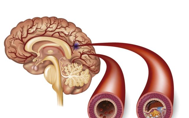 acv-isqu-mico-o-infarto-cerebral-s-ntomas-bupa