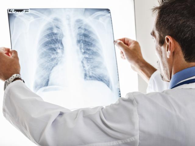 Médico revisando una radiografía de un paciente con neumonía.