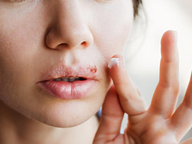 Mujer mostrando cómo prevenir el herpes labial.